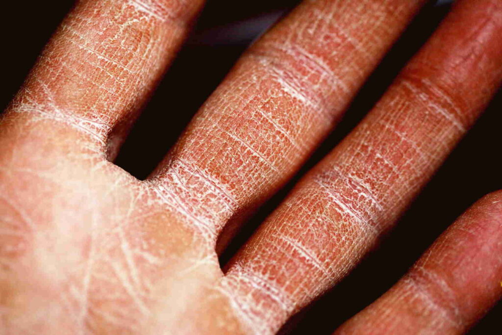 découvrez comment le cbd peut aider à soulager les symptômes du psoriasis grâce à ses propriétés anti-inflammatoires et apaisantes.